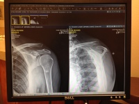 X-Ray of the grade 3 separated collar bone or AC.